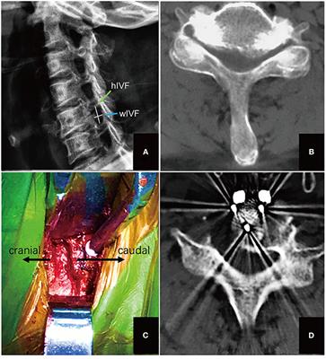 Intervertebral Foramen Width Is an Important Factor in Deciding Additional Uncinate Process Resection in ACDF—a Retrospective Study